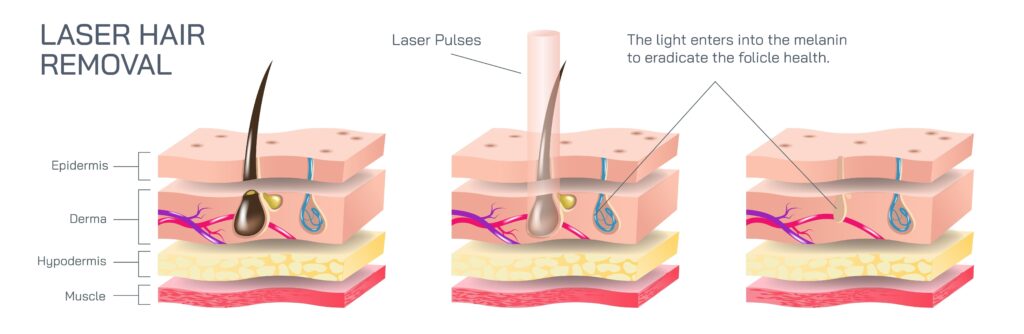 laser hair removal 2432430107