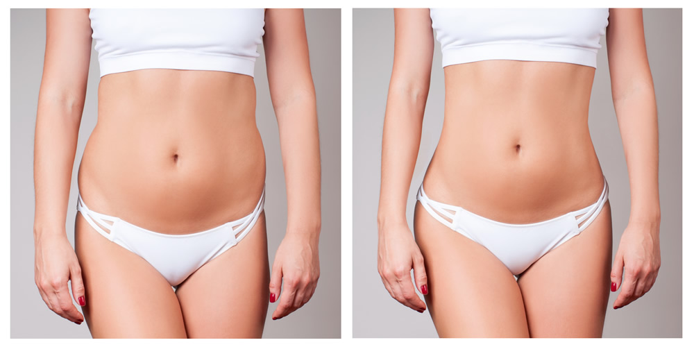 laser stomach coolsculpting 773024302