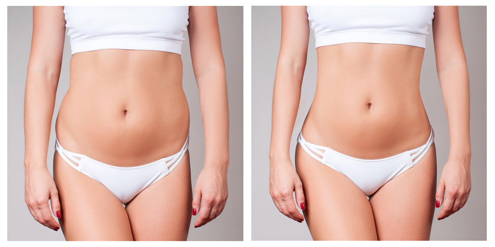 Laser Skin Tightening For Stomach Thermage CoolSculpting