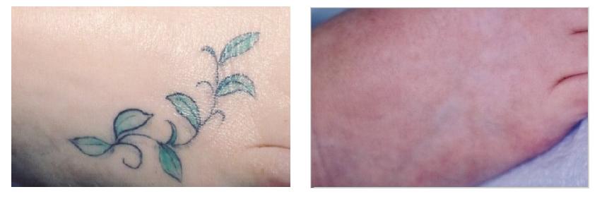 laser tattoo removal foot