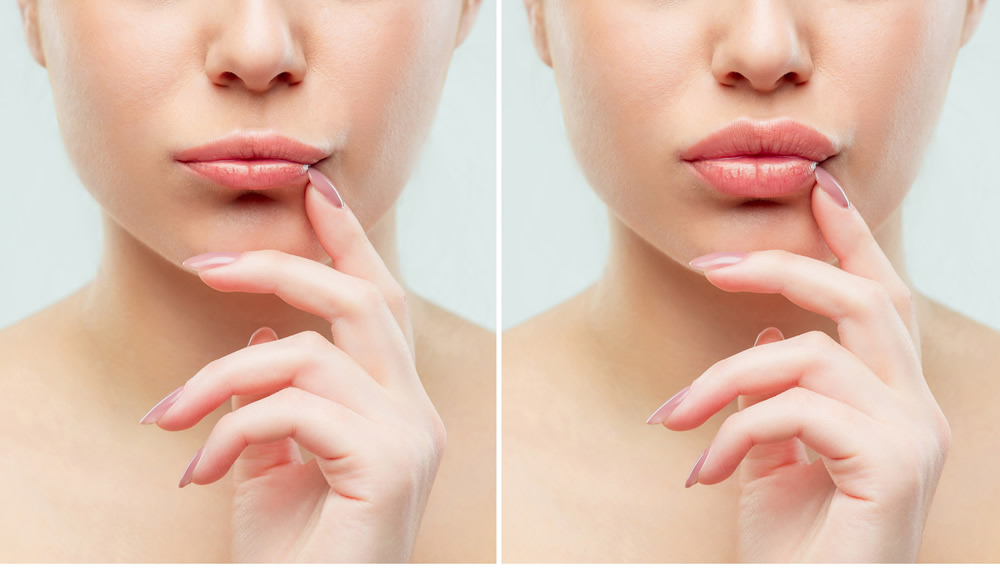 lips before after shutterstock1061184095