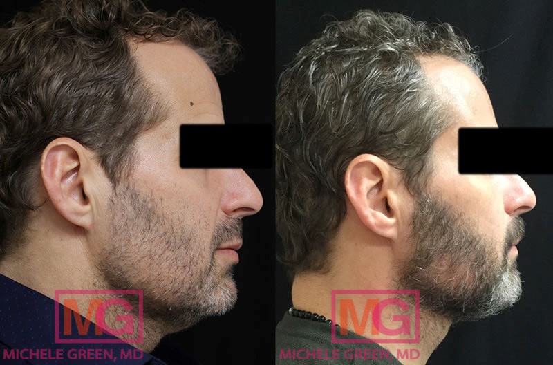 45-54 year old male treated with Thermage & Kybella