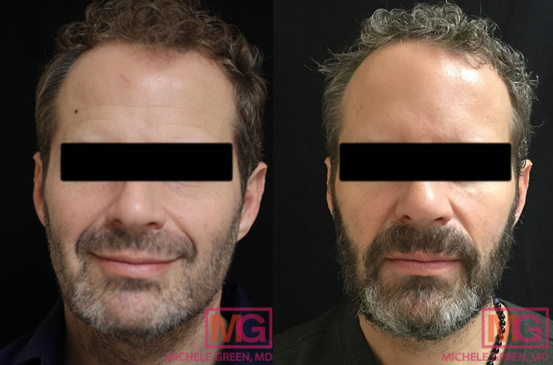 male 45 54 thermage kybella before after 1 1 MGwatermark