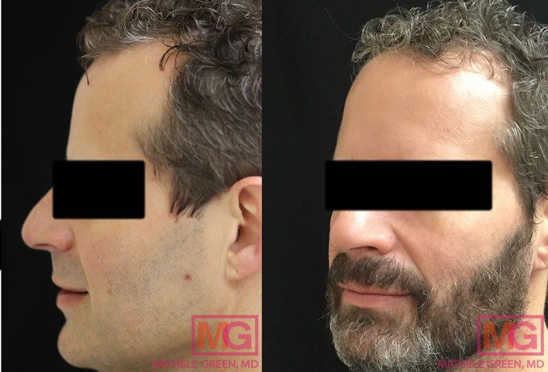 45-54 year old male treated with Thermage & Kybella