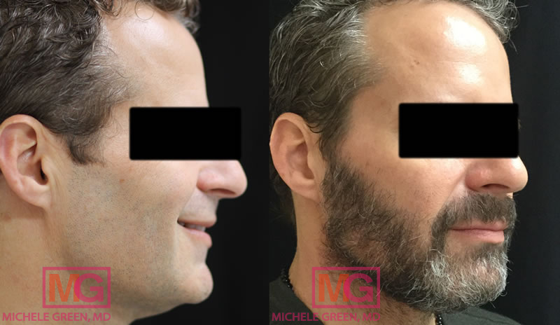 male 45 54 thermage kybella before after RIGHT A 1 MGwatermark