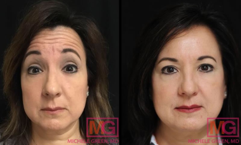 mb restylane botox glabella forehead FRONT MGWatermark 1