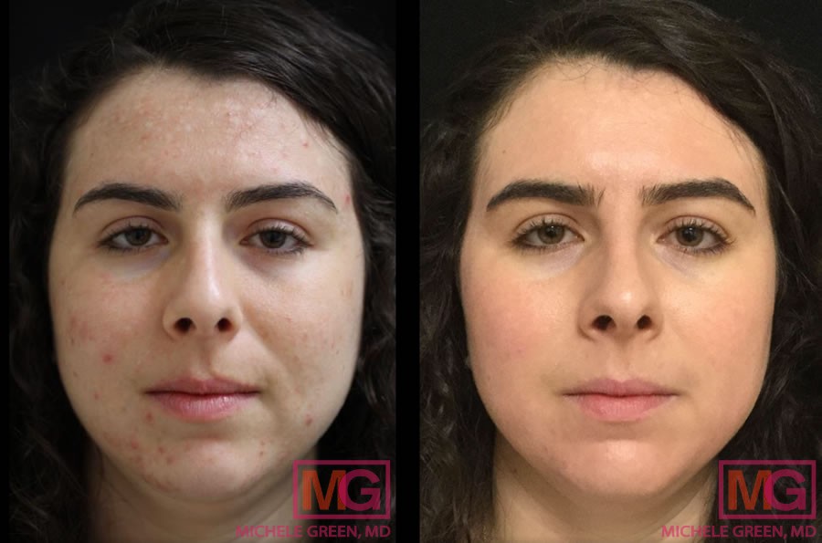 30 year old, 8 Months before and after Acne treatment