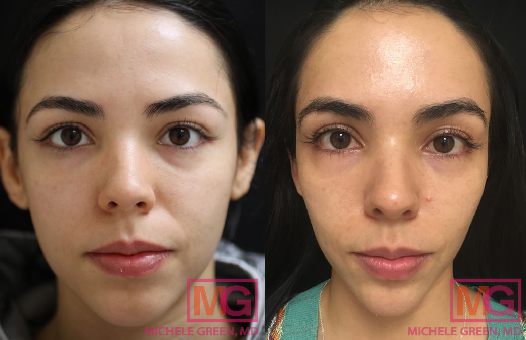 microneedling aquagold before after 24f MGwatermark