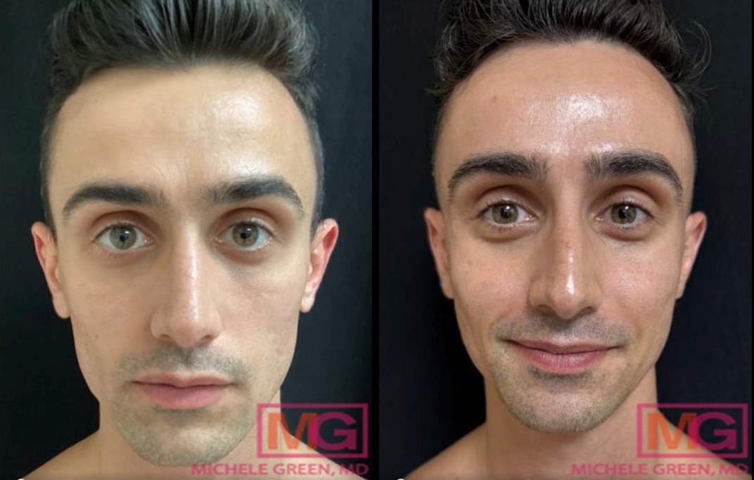 Sculptra for Acne Scars
