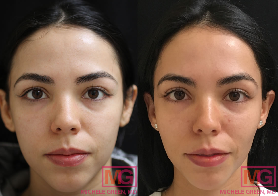 24 year old with PRP Facial and Voluma