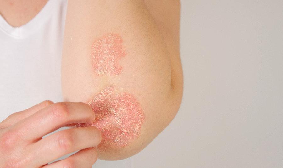 psoriasis skin rash