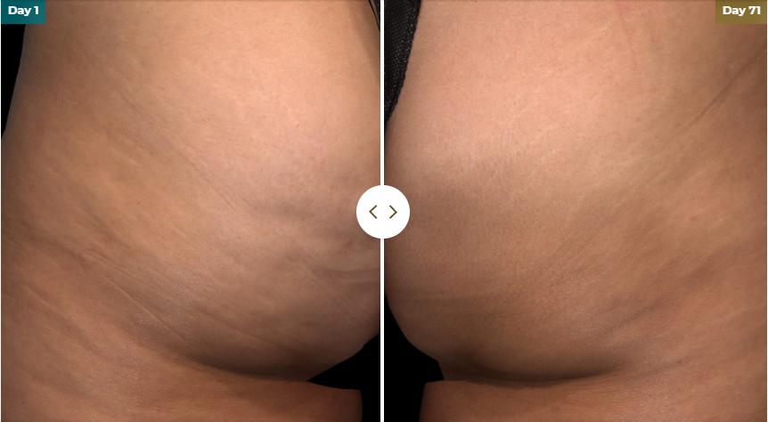 Cellulite Treatment NYC, Types of Treatment for Cellulite - Michele S.  Green, MD