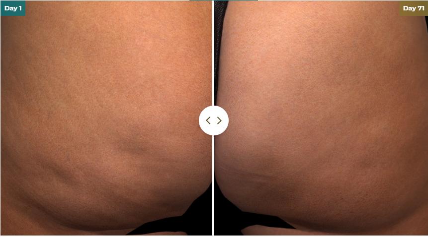 Cellulite Treatment NYC, Types of Treatment for Cellulite - Michele S.  Green, MD