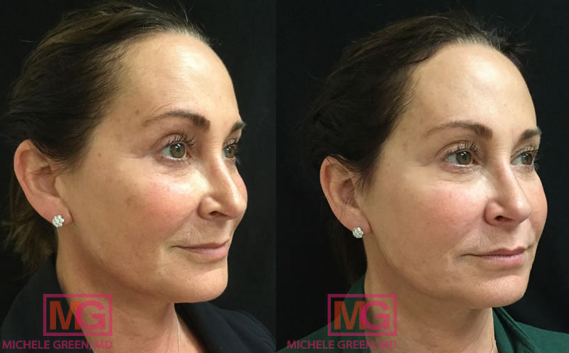 56 year old female treated with Vbeam, Restylane and Juvederm