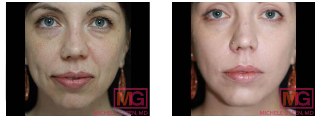Under Eye Bags Treatments  Eye Rejuvenation Macon & Madison, GA