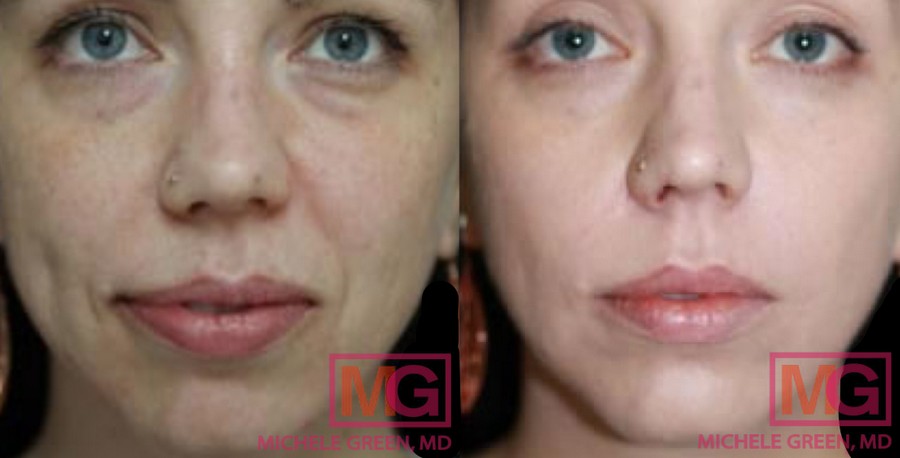 Female treated with Restylane