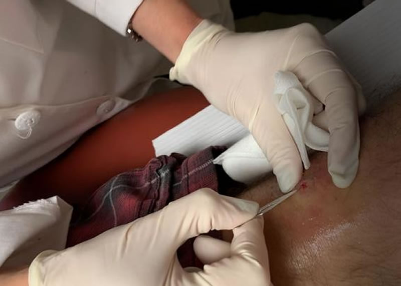 sebaceous cyst video shot 800