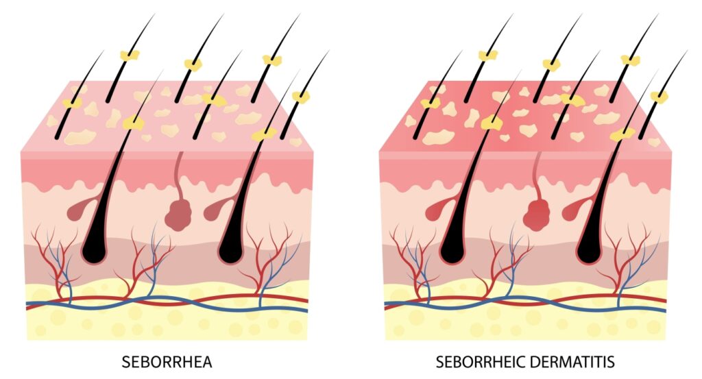 seborrheic dermatitis 2214822581
