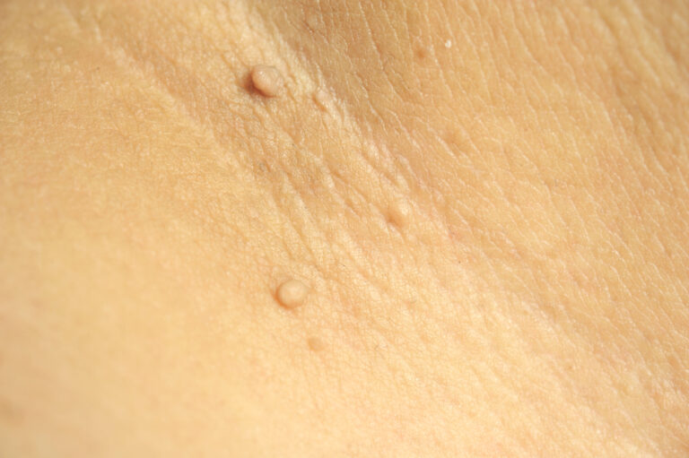 Skin Tags Neck, Causes & Removal Options - Dr. Michele Green M.D.