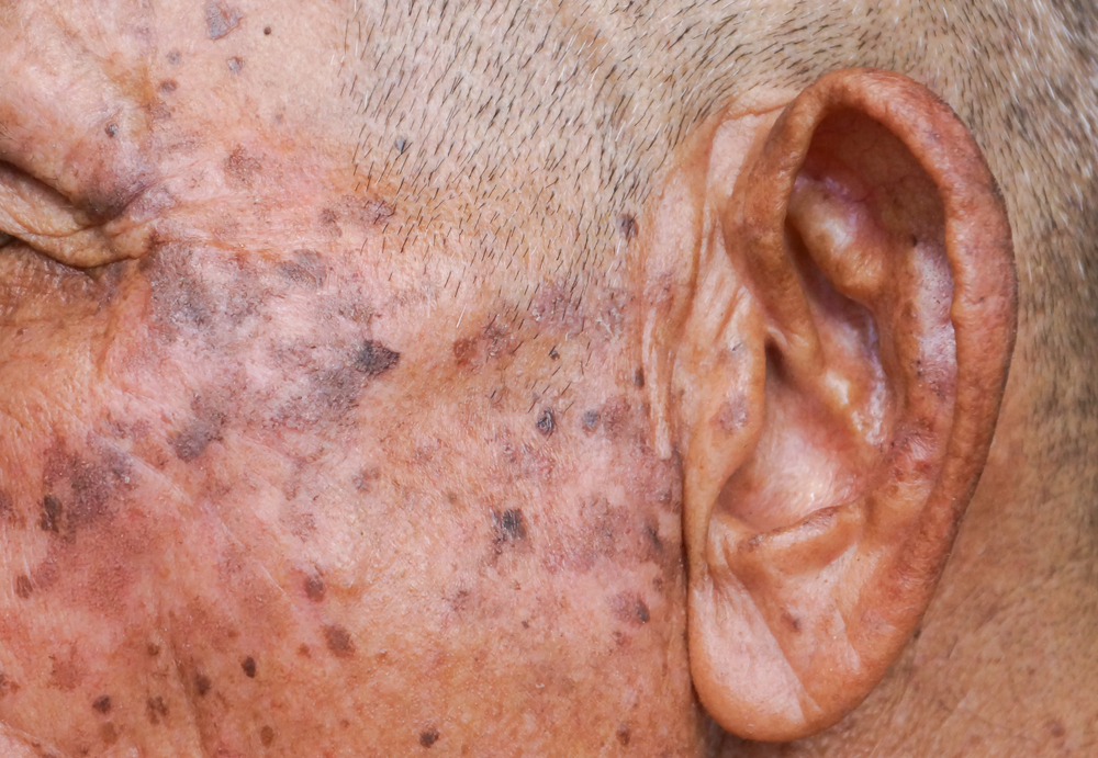 Old,Asian,Man's,Head,Full,Of,Freckles,And,Seborrheic,Keratosis,