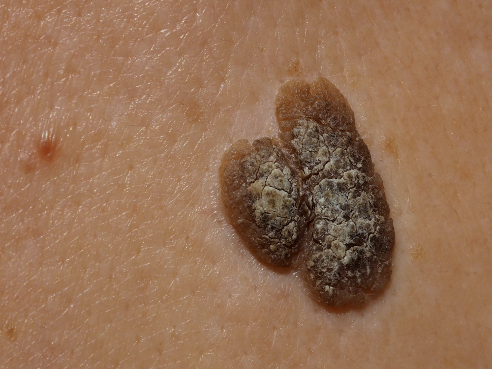 A,Photo,Of,Seborrheic,Keratosis,,Skin,Problem,Occurring,To,A
