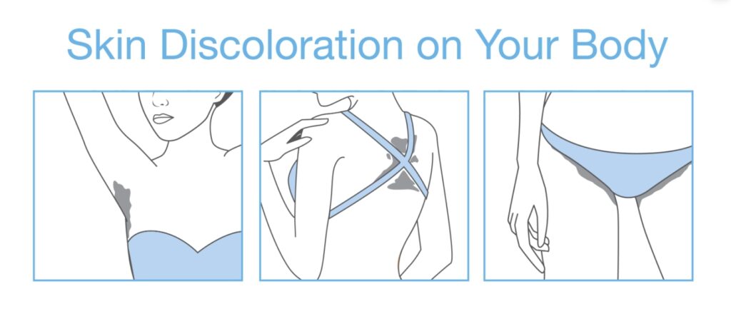 skin discoloration lightening