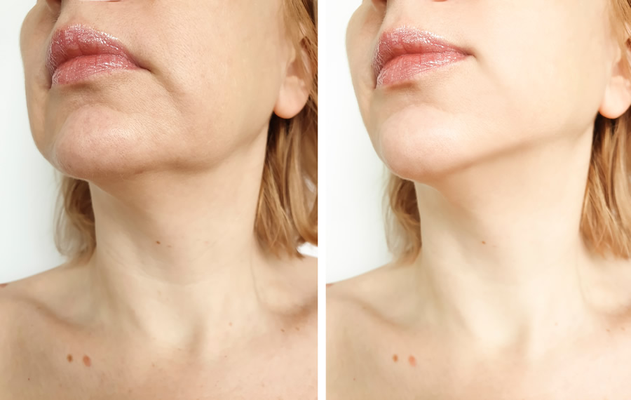 Laser Skin Tightening Before And After