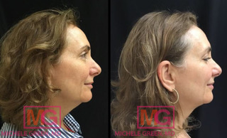 sm kybella thermage before after 3months RIGHT1 MGWatermark