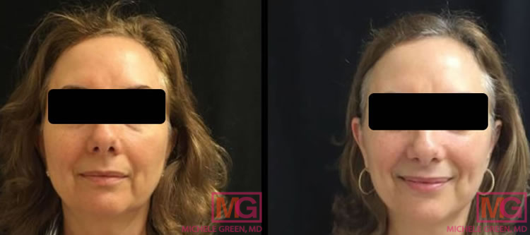 Female patient treated with Kybella & Thermage