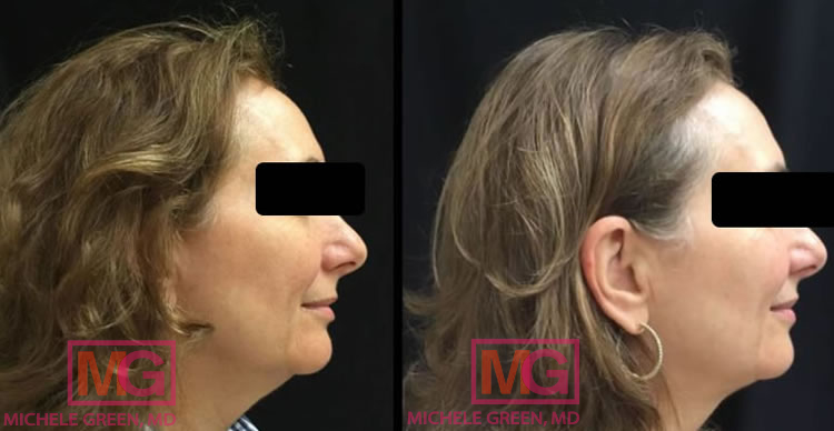 smb kybella thermage before after 4months RIGHTb MGwatermark