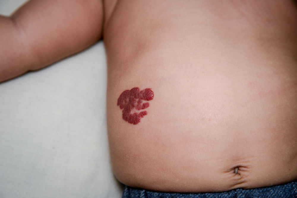 Infantile,Hemangioma,Red,Birthmark,(also,Called,Strawberry,Mark),On,The