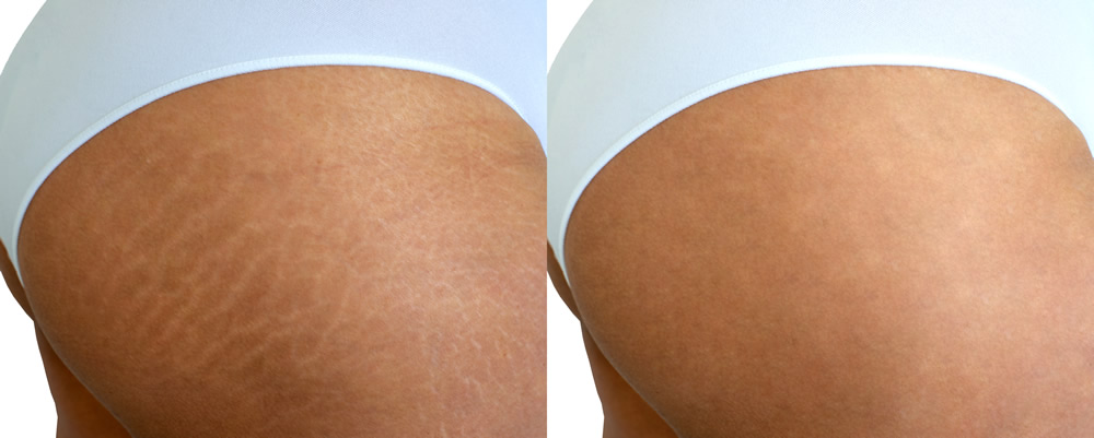 stretch marks 1836006871
