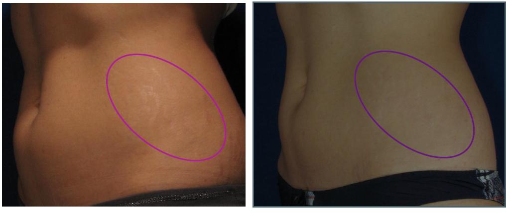 stretch marks flank 2 syneron candela