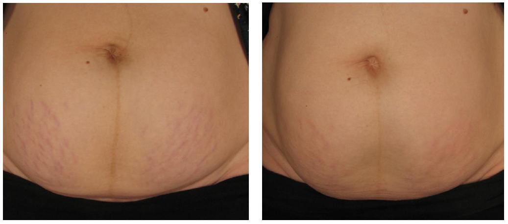 stretch marks front syneron candela