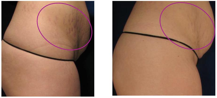 Laser Stretch Mark Removal, What You Need to Know