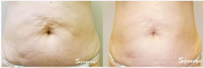 syneron: velashape abs