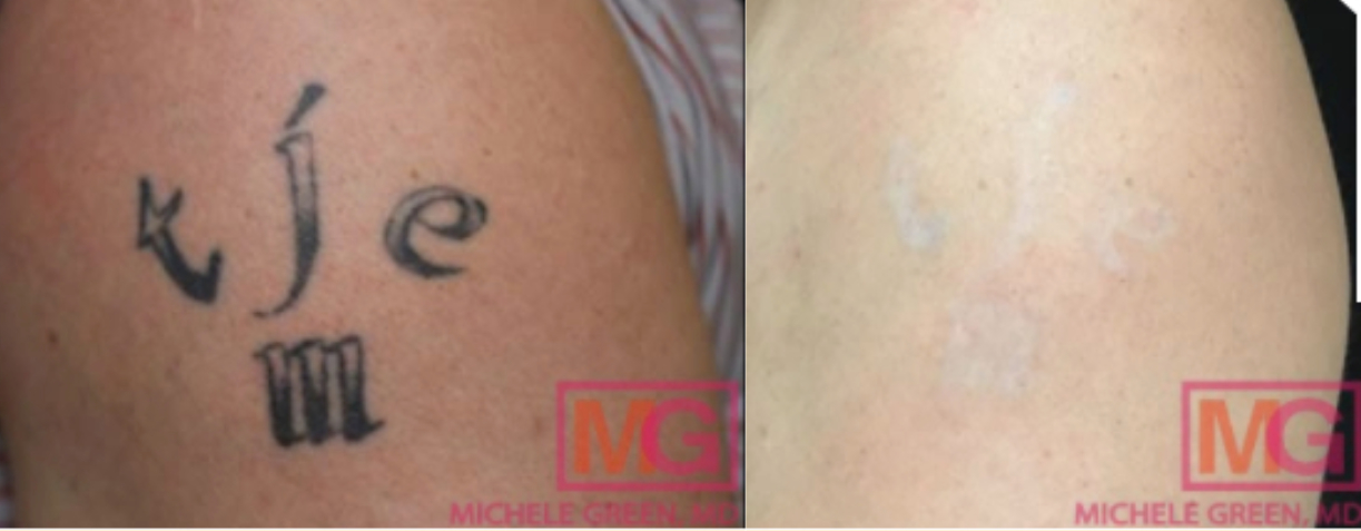 Laser Tattoo Removal NYC, Tattoo Removals, Costs & Info