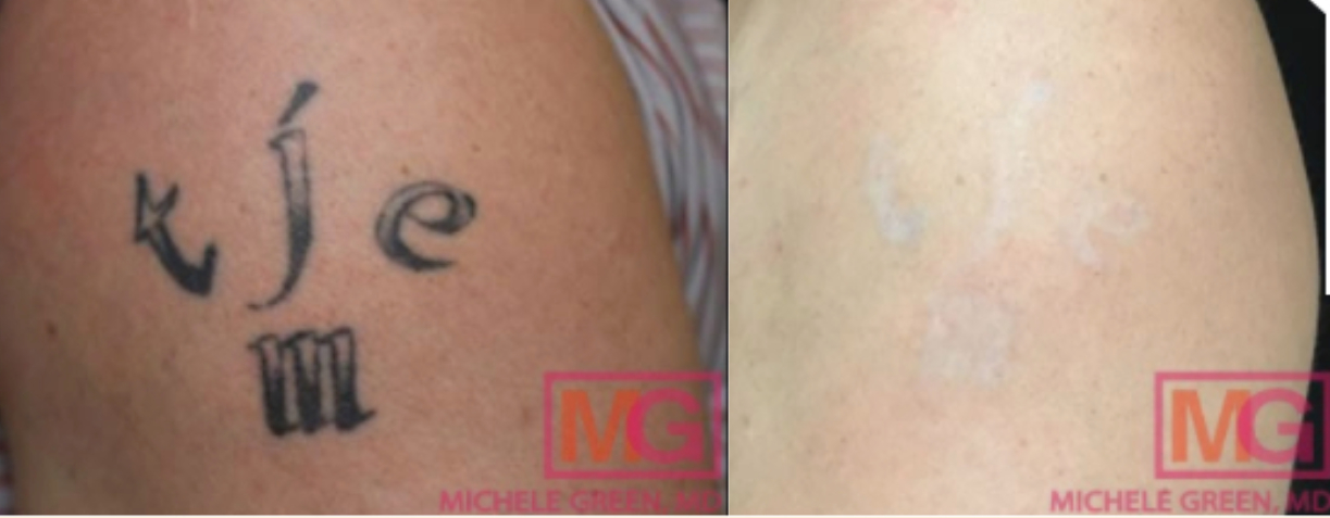 surgical tattoo removal cost