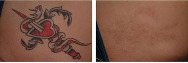 Laser Tattoo Removal NYC Tattoo Removals Costs Info