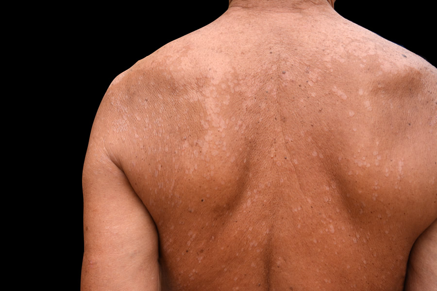 Frontal tinea corporis followed by tinea capitis.