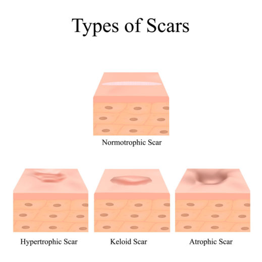 Acne Scar Removal Costs, Average Prices of Acne Scar Treatment Options 2021