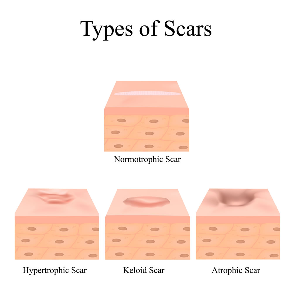 types of acne scars 647145096