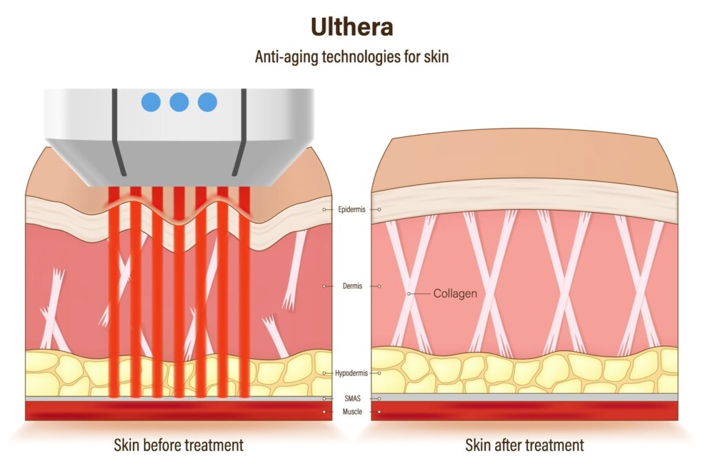 ultherapy diagram