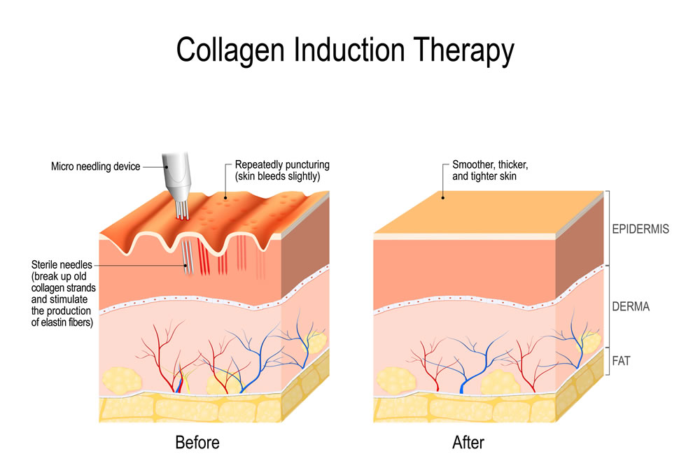microneedling collagen induction therapy 1089496223