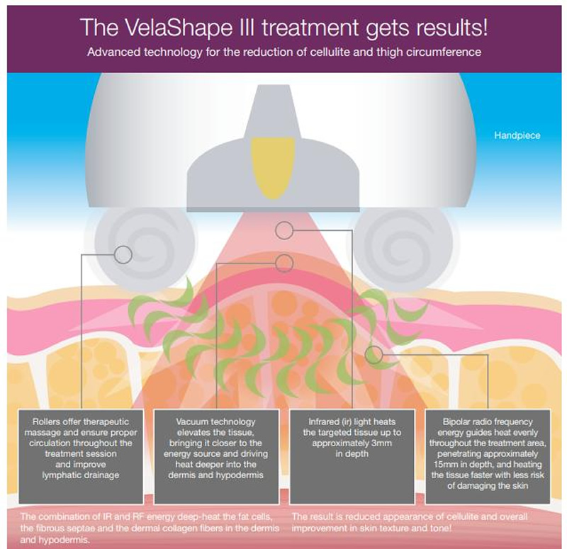 velashape diagram 800