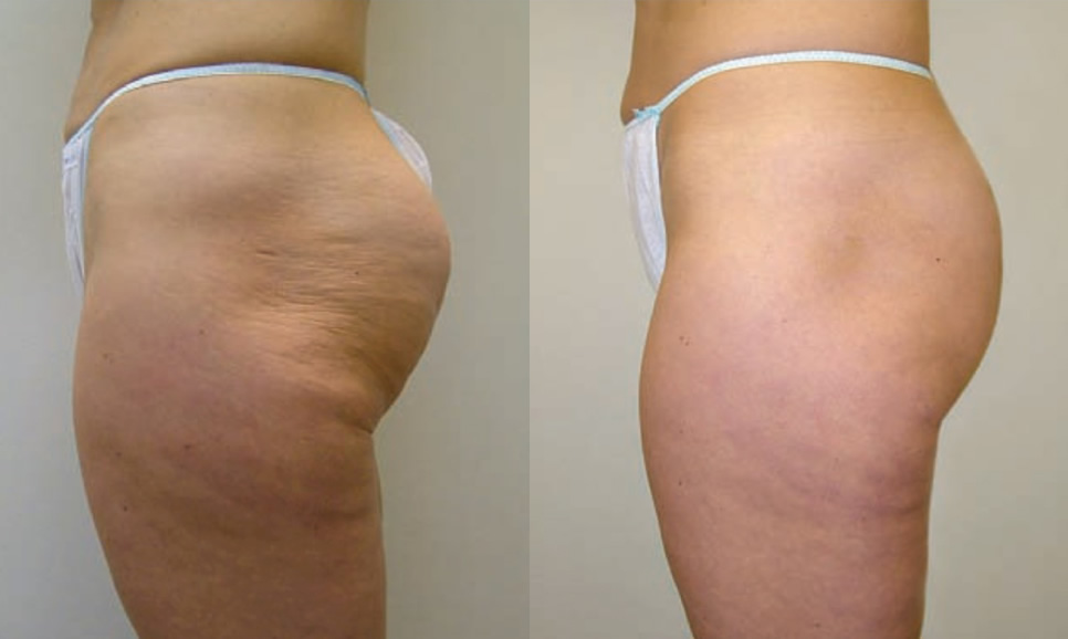 velashape iii before after photo - source: syneron