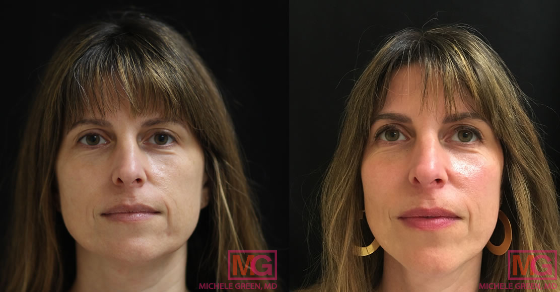 35-44 year old woman treated with Voluma