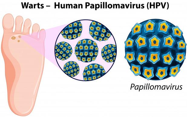 wart diagram