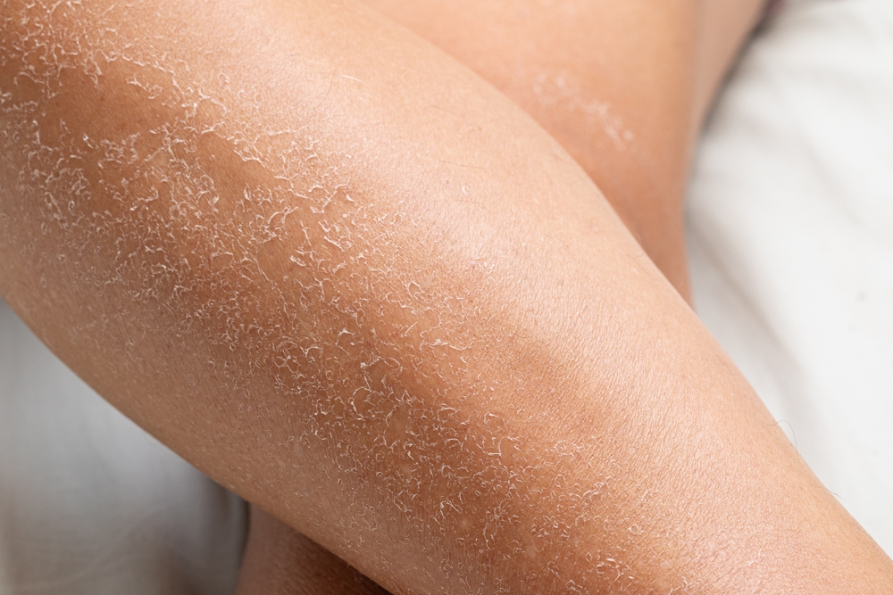Macro,Of,Detail,Of,Dry,Skin,Of,Woman,Legs.,Close